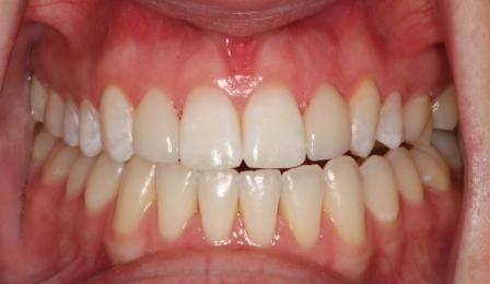 Veneers After