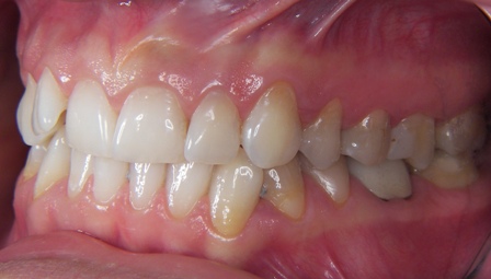 Before Left side