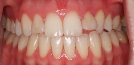 Veneers before