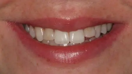 Smile before